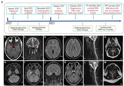 Case report: A novel case of COVID-19 triggered tumefactive demyelinating lesions in one multiple sclerosis patient